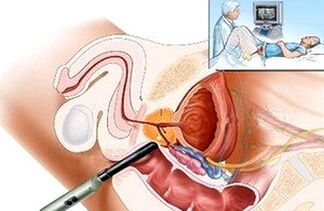Possibilités de diagnostic de prostatite