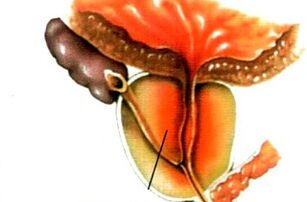 Qu'est-ce que la prostatite chez les hommes