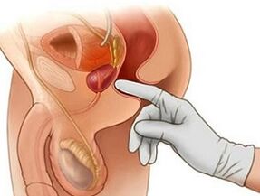 Massage de la prostate pour traiter la prostatite chez l'homme