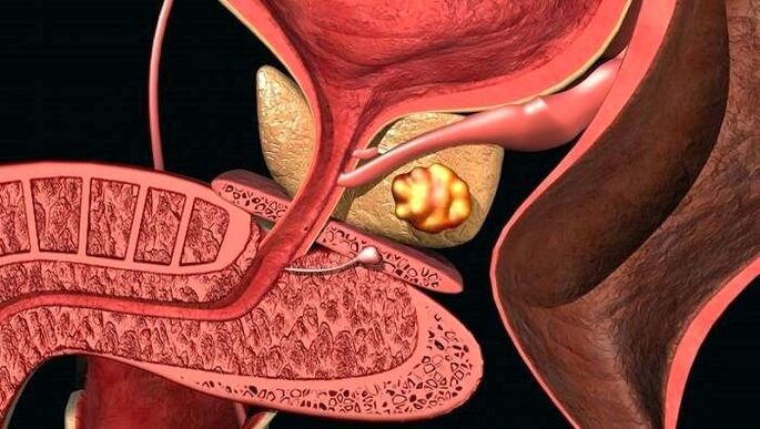 Dépôts de calculs dans la prostate dans la prostatite calcifiée