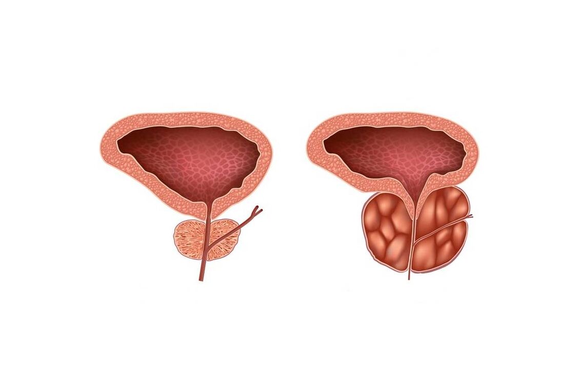 Symptômes de la prostatite chez les hommes